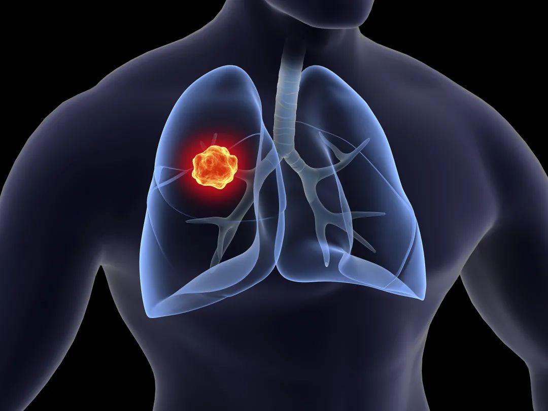 肺癌ct图片症状解析图,正常肺部胸片 正常人 - 伤感说说吧
