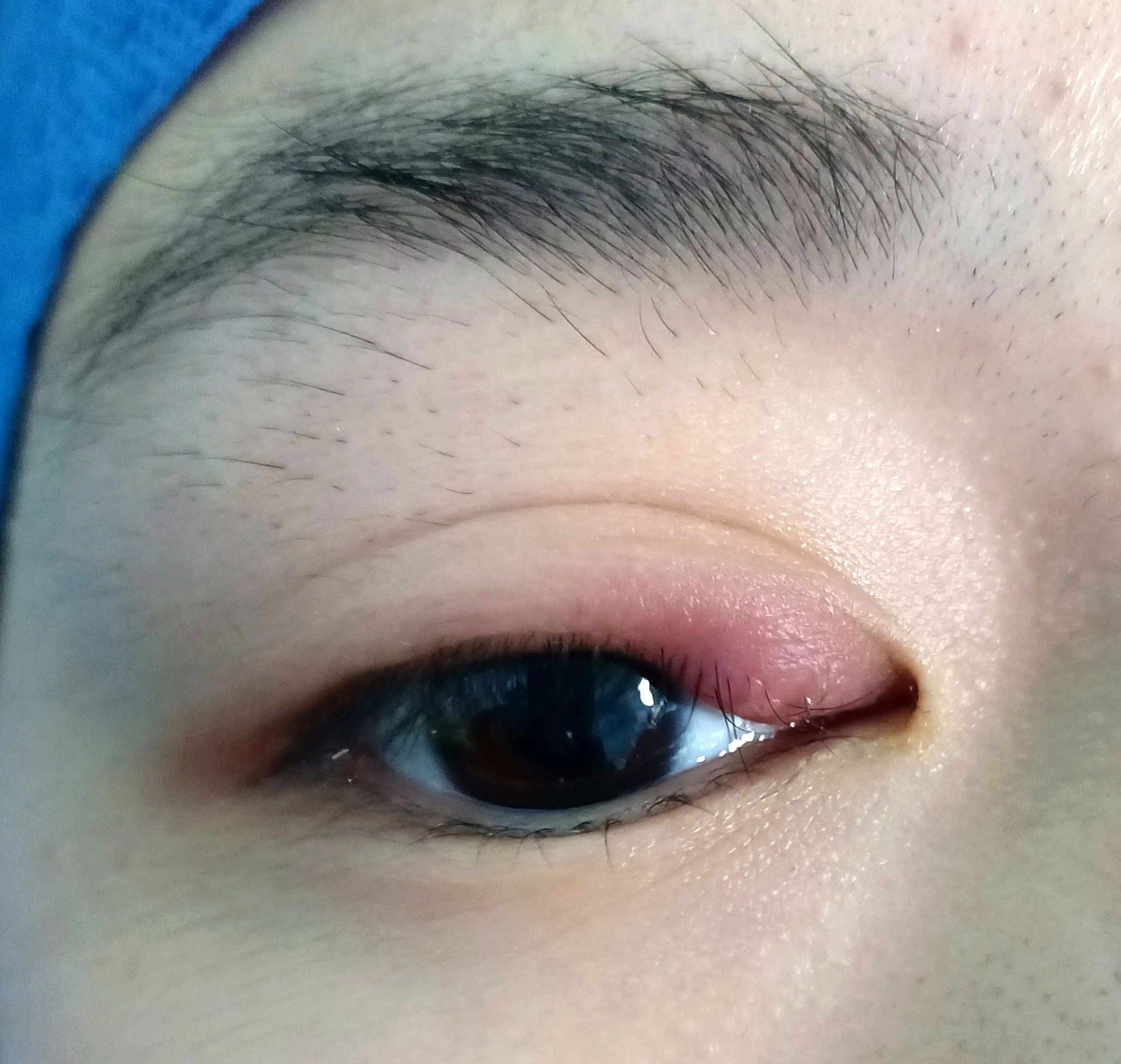 麦粒肿？霰粒肿！认识这个“慢性子”的眼科疾病-国家老年疾病临床医学研究中心中文版